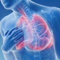 Wie kann ich Asthmaanfällen vorbeugen?